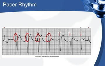 Cardiac Days rhythmical Part 2 | Educreations